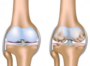 Thoái hóa khớp gối gây nguy hiểm như nào cho người bệnh?